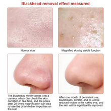 Visible Camera Blackhead Remover Vacuum Suction FLIXME WORLD